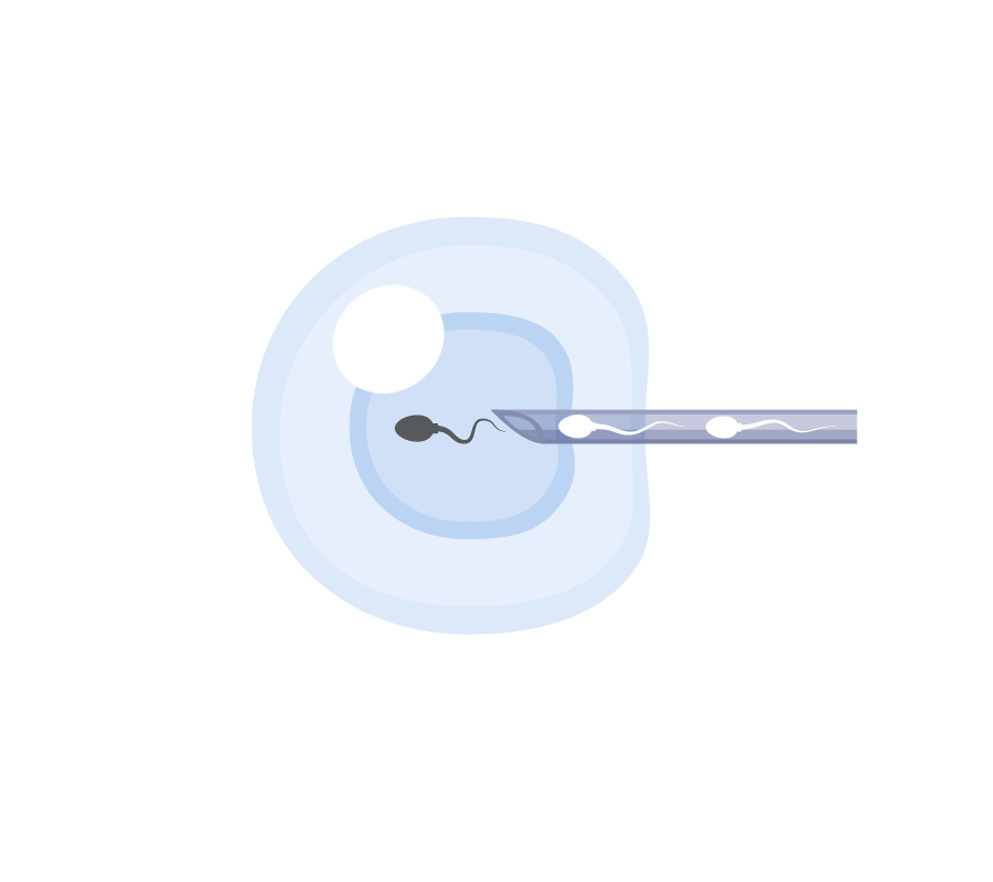 试管婴儿-01 使用 ICSI 进行体外受精 (IVF/ICSI)